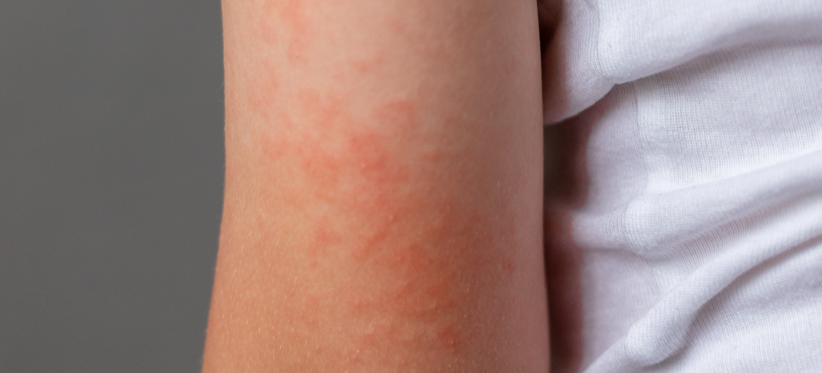 Acesse a notícia comleta: TRF5 garante fornecimento de medicamento a adolescente com dermatite atópica grave